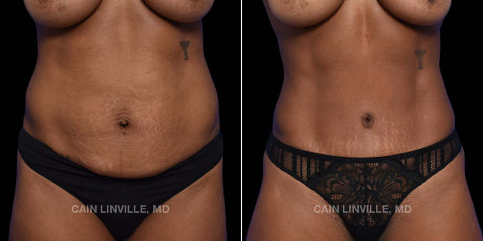 This patient is a 43 year old female who received a tummy tuck in combination with lipo 360 and bodytite with a hernia repair. These photos are 5 months post op.