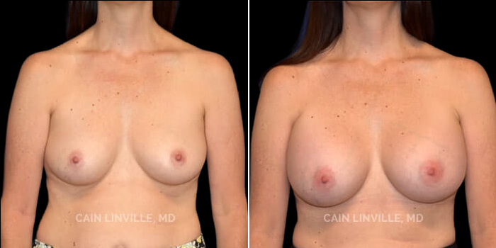 Patient 12 Front View Breast Augmentation Linville Plastic Surgery