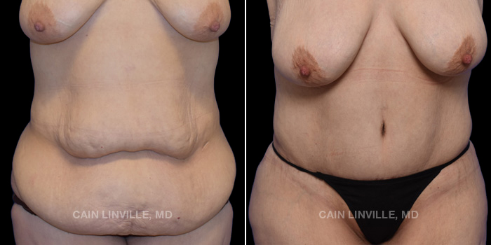 This patient is a 48 year old female who received a tummy tuck in combination with liposuction. These photos are 1 year post op.