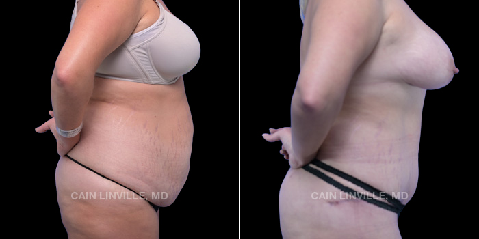 This patient is a 38 year old female who received a tummy tuck, liposuction 360, and bodytite. These photos are 4 months post op.