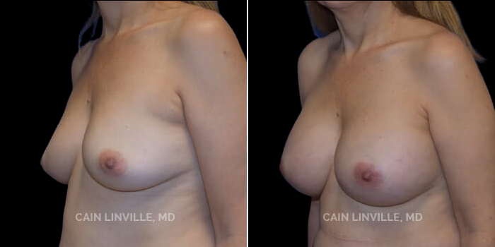 Patient 13 3/4th Left Side View Breast Augmentation Linville Plastic Surgery