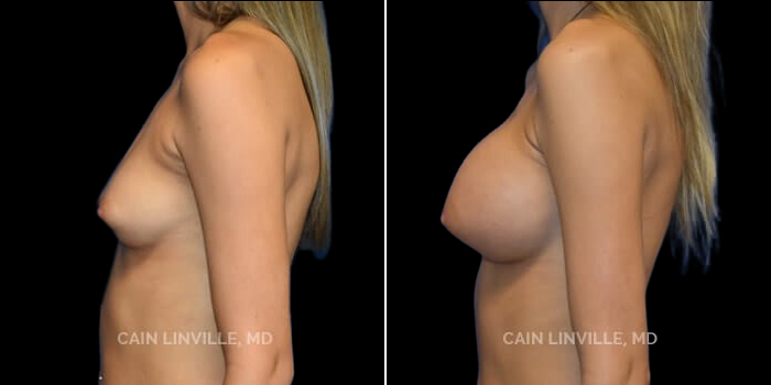 Patient 14 Left Side View Breast Augmentation Linville Plastic Surgery