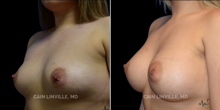 Patient 15 3/4th Left Side View Breast Augmentation Linville Plastic Surgery