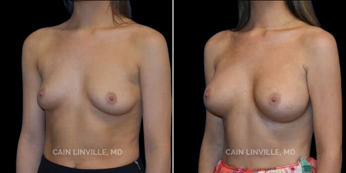 Patient 16 3/4th Left Side View Breast Augmentation Linville Plastic Surgery