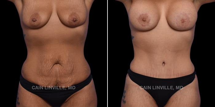 This patient is a 34 year old female who received a tummy tuck in combination with Lipo360, a mini BBL, and a breast augmentation. These photos are 3 months post op.