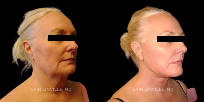 Patient 01 3/4th Right View Face and Neck Lift Linville Plastic Surgery