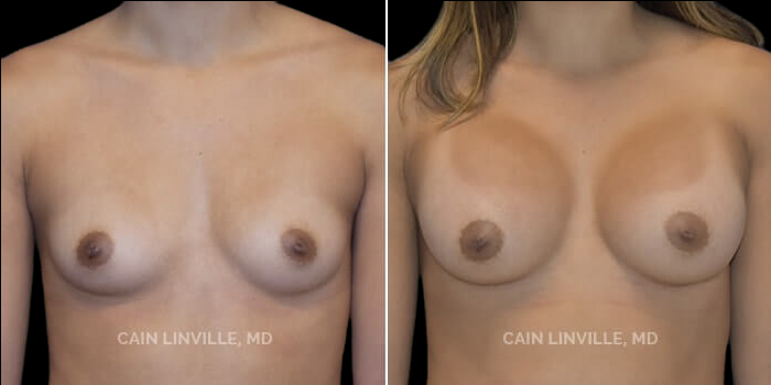 Patient 17 Front View Breast Augmentation Linville Plastic Surgery