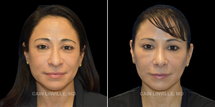 47-year-old underwent rhinoplasty with septoplasty, quad blepharoplasty with fat grafting to cheeks and lower lids. Submental liposuction with facetite to cheeks, jowls and neck.
