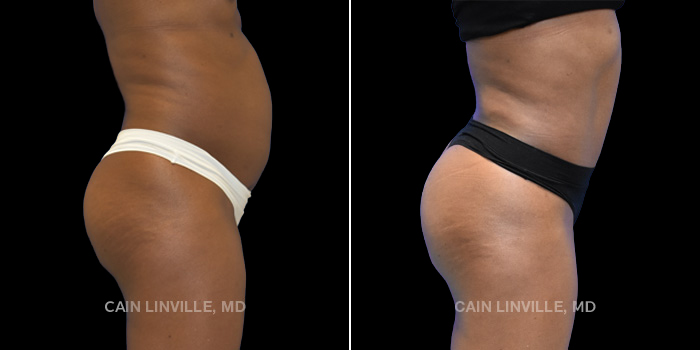 55 yr old underwent tummy tuck with hernia repair along with Brazilian butt lift. Injected 300 cc to each side to improve projection and shape.