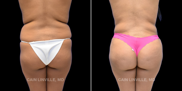This patient is a 27 year old female who underwent a tummy tuck, 360 lipo with bodytite, and fat grafting to buttocks (BBL). These photos are 6 months post op.
