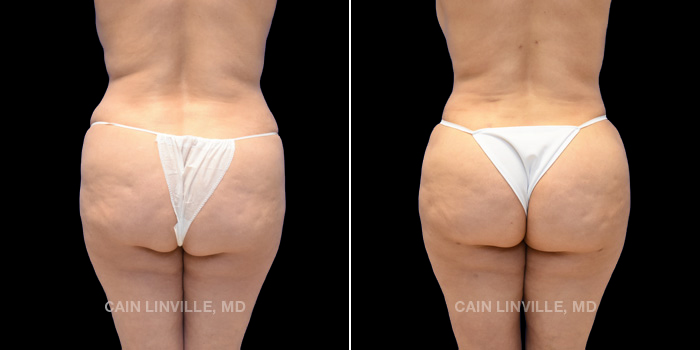 42 year old underwent tummy tuck revision, liposuction 360 with bodytite. Brazilian buttock lift with 800 cc injected on each side for shape and contour with bodytite to banana roll for improved buttock crease.