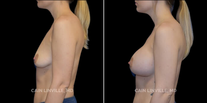 Patient 18 Left Side View Breast Augmentation Linville Plastic Surgery