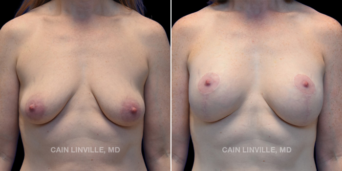 This patient is a 44 year old female who received a breast lift with implants. These photos are 1 year post op.