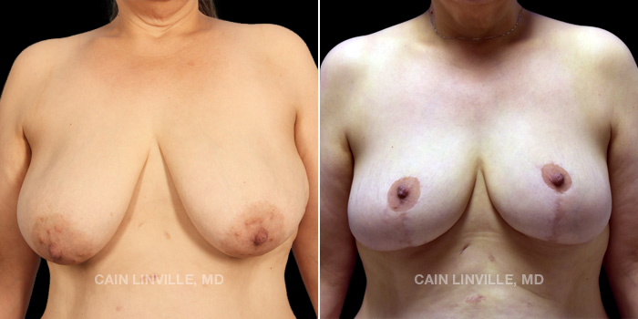 Patient #87 – 52 years old Procedures Depicted – Breast Reduction and Lift