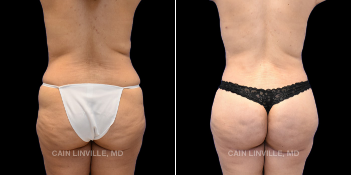 This patient is a 39 year old female who received a thigh lift, body lift, liposuction to abdomen, back, flanks, lateral thighs, medial thighs, submental area, and bra-line with bodytite to abdomen, flanks, bra-line, back, thighs, and arms. She also received facetite to the submental area with filler to her chin. The patient received fat grafting to her buttocks (BBL). These photos are 3 months post op.