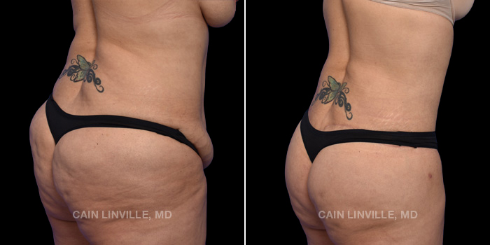 This patient is a 50 year old female who received a tummy tuck in combination with liposuction 360, bodytite 360, and a Brazilian buttock lift. These photos are 3 months post op.