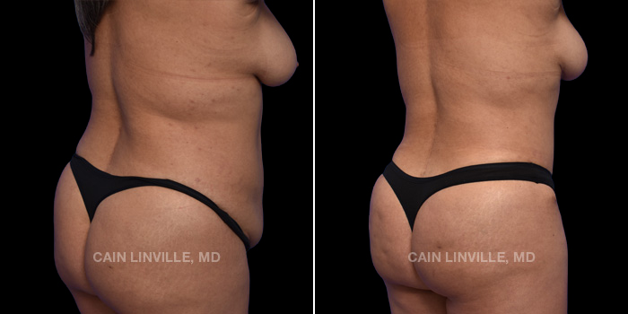This patient is a 46 year old female who received Liposuction 360 with fat grafting to the buttocks (BBL). These photos are 3 months post op.