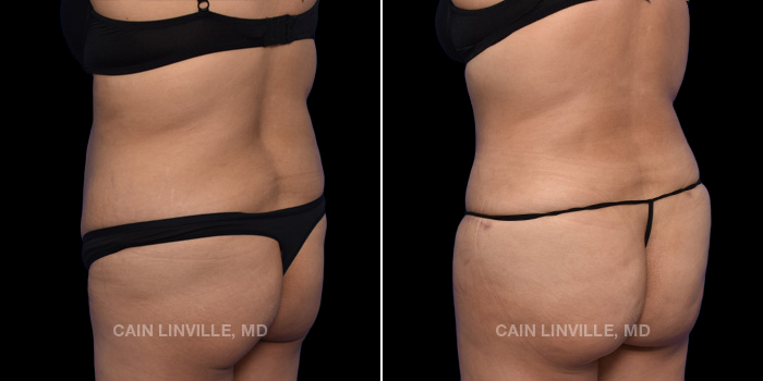 This patient is a 32 year old female who received a tummy tuck in combination with lipo360 and bodytite with fat grafting to the buttocks. These photos are 5 months post op.