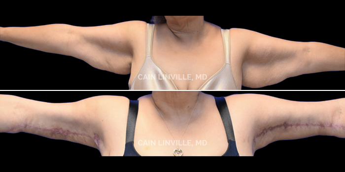 This patient is a 61 year old female who received a brachioplasty. These photos are 3 months post op.