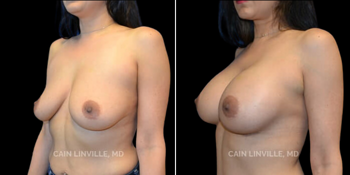 Patient 19 3/4th Left Side View Breast Augmentation Linville Plastic Surgery