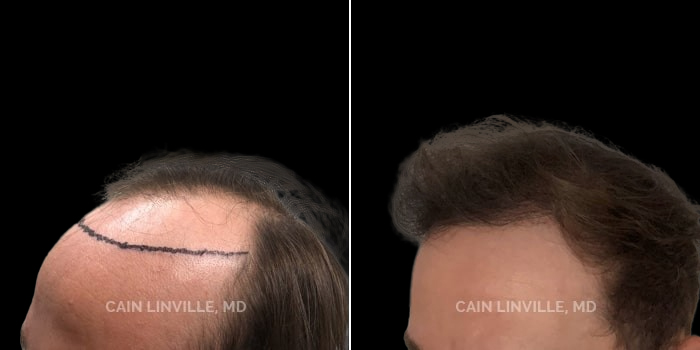 Patient 02 3/4th Left View Neograft Hair Restoration Linville Plastic Surgery