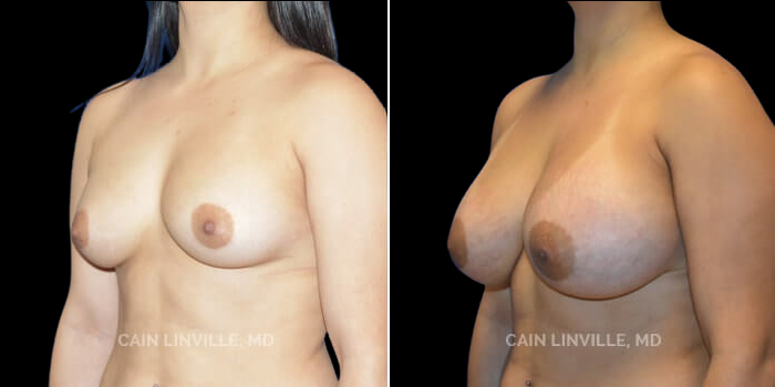B to D cup and upper pole fullness. This patient desired a significant increase in breast size along with upper pole fullness. 445 cc gummy bear cohesive Natrelle implants were placed in a dual plane I position, through an inframammary incision. She has a very nice result without being too large and with improved fullness throughout the breast.