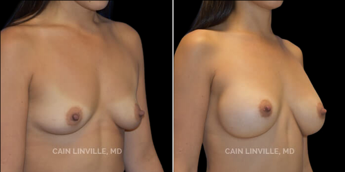 Patient 21 3/4th Right Side View Breast Augmentation Linville Plastic Surgery