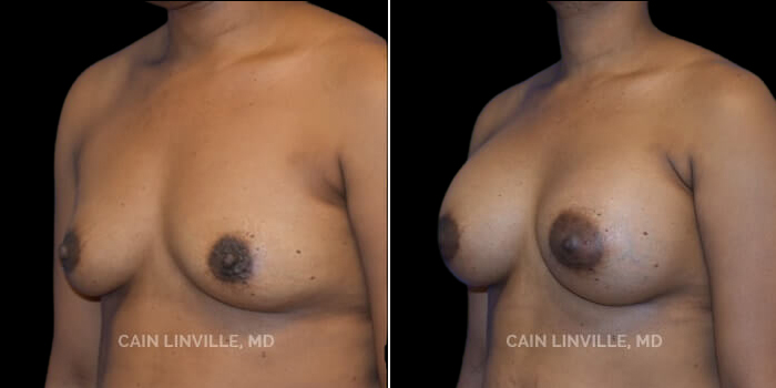 Patient 22 3/4th Left Side View Breast Augmentation Linville Plastic Surgery