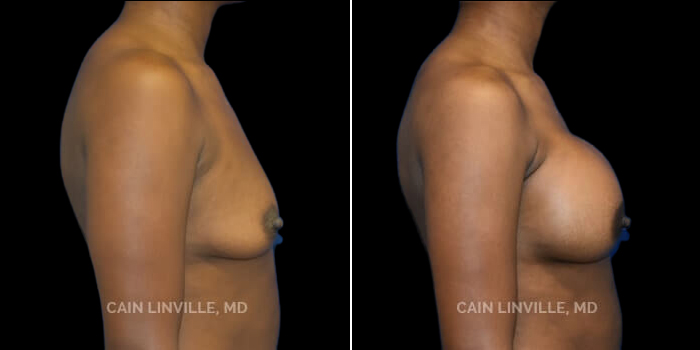 Patient 23 Right Side View Breast Augmentation Linville Plastic Surgery