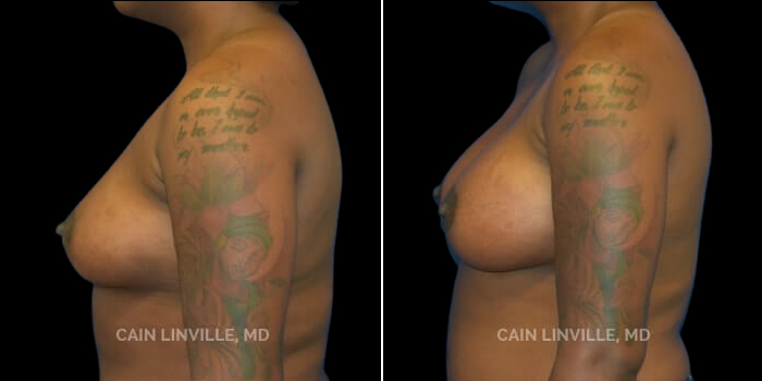 Patient 24 Left Side View Breast Augmentation Linville Plastic Surgery