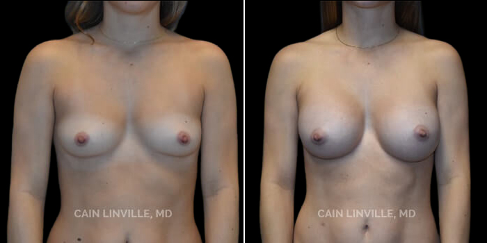 Patient 25 Front View Breast Augmentation Linville Plastic Surgery
