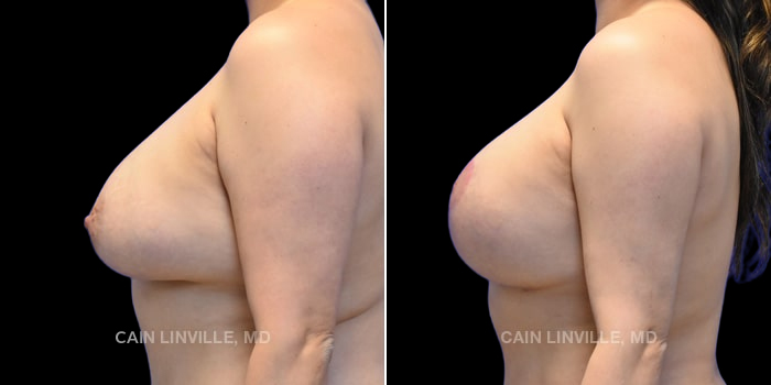 42-year-old underwent breast revision of a vertical mastopexy with exchange of implants to 580cc SCX.
