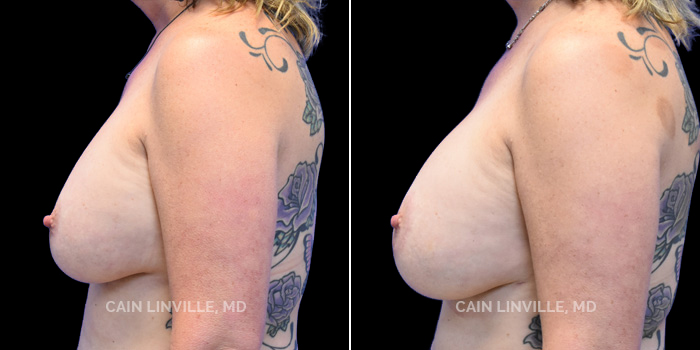 This patient is a 46 year old female who received a breast implant exchange in combination with liposuction to her abdomen, back, and flanks. These photos are 5 months post op.