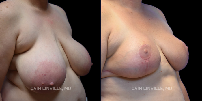 Patient 06 3/4th Right Side View Breast Reduction Linville Plastic Surgery