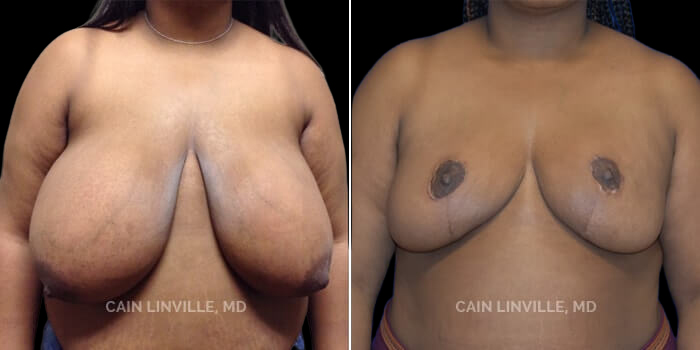 Patient 05 Front View Breast Reduction Linville Plastic Surgery