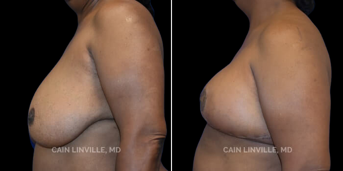 Patient 04 Left Side View Breast Reduction Linville Plastic Surgery