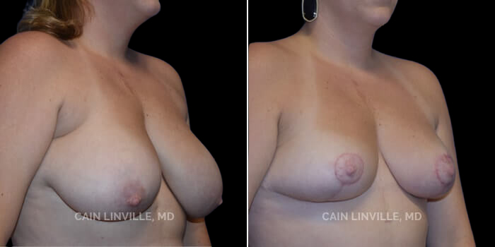 Patient 03 3/4th Right Side View Breast Reduction Linville Plastic Surgery