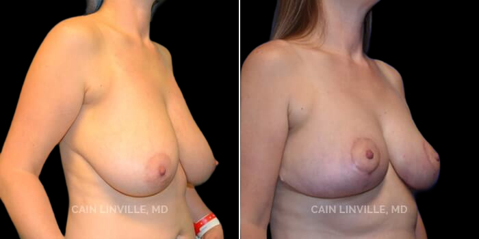 Patient 02 3/4th Right Side View Breast Reduction Linville Plastic Surgery