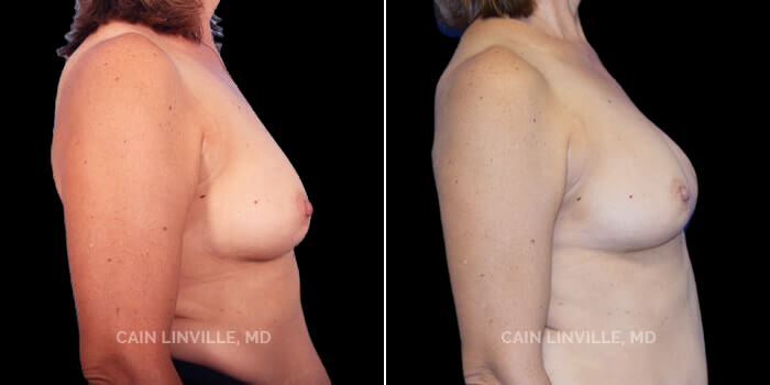 This 50 yo woman underwent a left mastectomy for cancer, but did not want the right breast altered. The tumor was too close to the nipple to spare, so her mastectomy was skin-sparing. She initially had a tissue-expander in place, but opted for a left unilateral DIEP flap. This is a great example of how a DIEP flap, even if used on one side, can help with symmetry, as it appears very natural, and behaves and looks like a normal breast. She later had nipple reconstruction followed by 3-D areola tattooing, and has a near-perfect symmetric result.