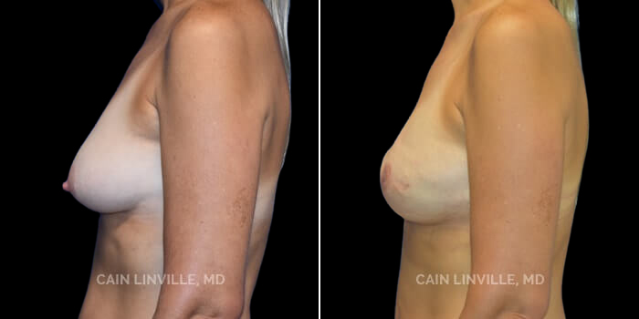 This is another 55 yo woman, who is an avid runner, who also was a great candidate for tissue expanders and then implants with fat grafting. She too, wanted to be slightly bigger and more symmetric than her original shape, and the expanders helped with this significantly. She had a pre-pectoral expander/implant position, which is beneficial for a number of reasons as illustrated here: the implant is not inhibited by the muscle and she does not have an animation deformity; the implant is allowed to reveal its natural shape and contour, giving her a more natural look; she had very little pain after surgery due to the fact that the reconstruction was above the muscle. She desired a natural shape, so tear-drop, anatomic implants were chosen to achieve natural aesthetic lines.