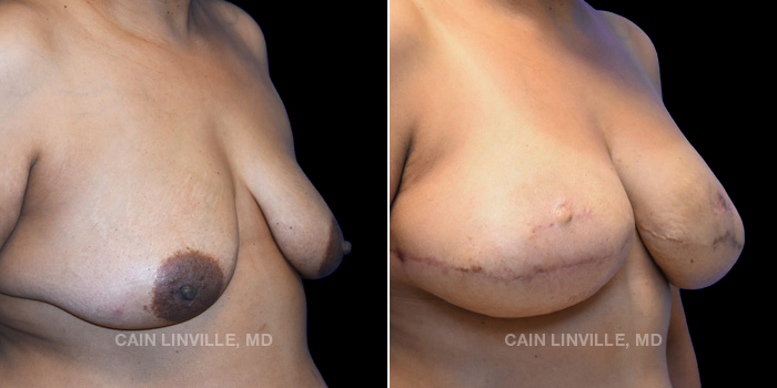 48-year-old female underwent reconstructive surgery. Bilateral DIEP flap with fat grafting and nipple reconstruction.