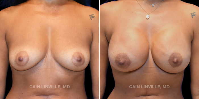 44-year-old female underwent reconstructive surgery. Bilateral tissue expanders replaced with silicone anatomically shaped breast implants and fat grafting.