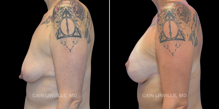 36 year old female who received a breast lift with implants. These photos are 6 months post op.