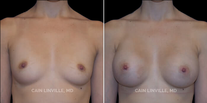 This young 24 year old woman desired an increase in size that wouldn’t make her chest too wide due to her petit frame. She wanted to go from a B cup to a full C cup for enhanced roundness and volume. 375 cc highly cohesive silicone implant, dual plane 0.5 pocket, inframammary incision. The implants gave her enhanced projection which allowed for an increase in volume without excessive widening of the chest. This augmentation method helped to achieve the look she dreamt of.