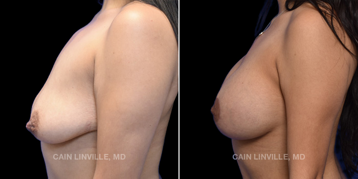 Patient 12 Left Side View Breast Lift Linville Plastic Surgery
