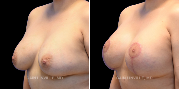 Patient 11 3/4th Left Side View Breast Lift Linville Plastic Surgery