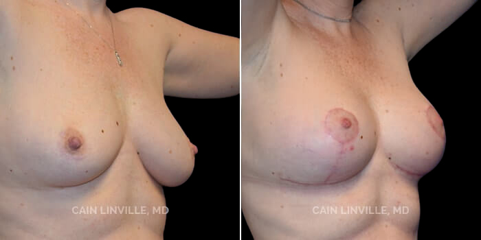 Patient 1 3/4th Right Side View Breast Lift Linville Plastic Surgery