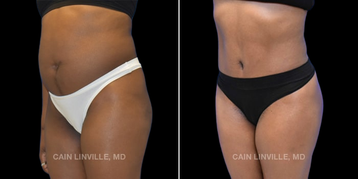 55-year-old underwent tummy tuck with liposuction to abdomen, waist, back and hernia repair.Along with Brazilian buttock lift.