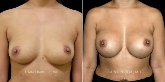 Patient 09 3/4th Left Side View Breast Augmentation Linville Plastic Surgery