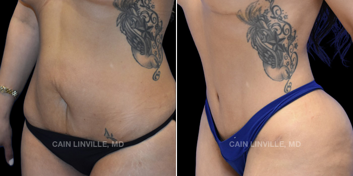 37 y/o female received a tummy tuck with liposuction 360. Photos are 1 year post op.
